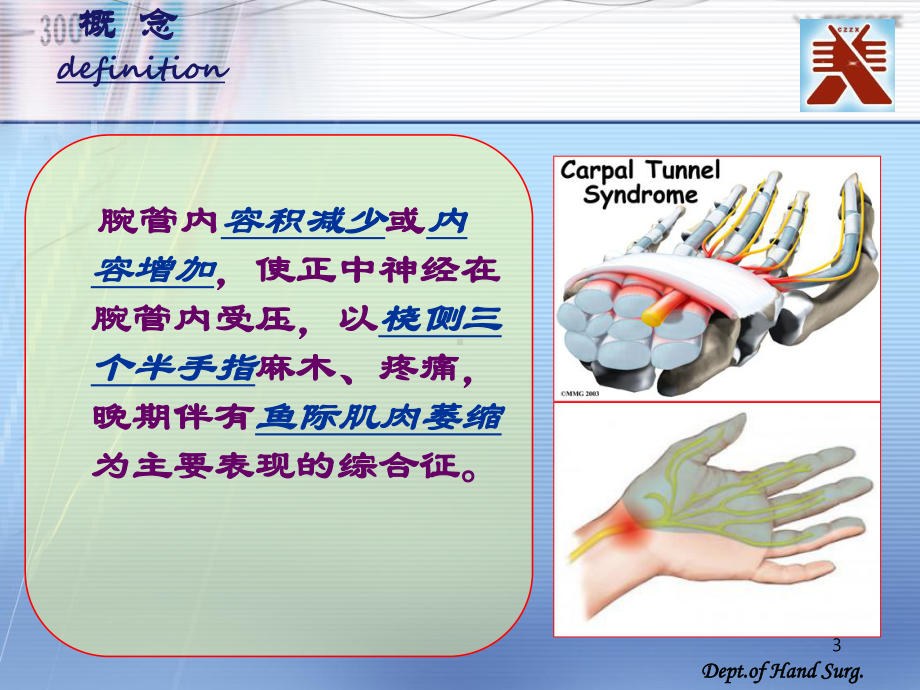 腕管综合征PPT课件.ppt_第3页