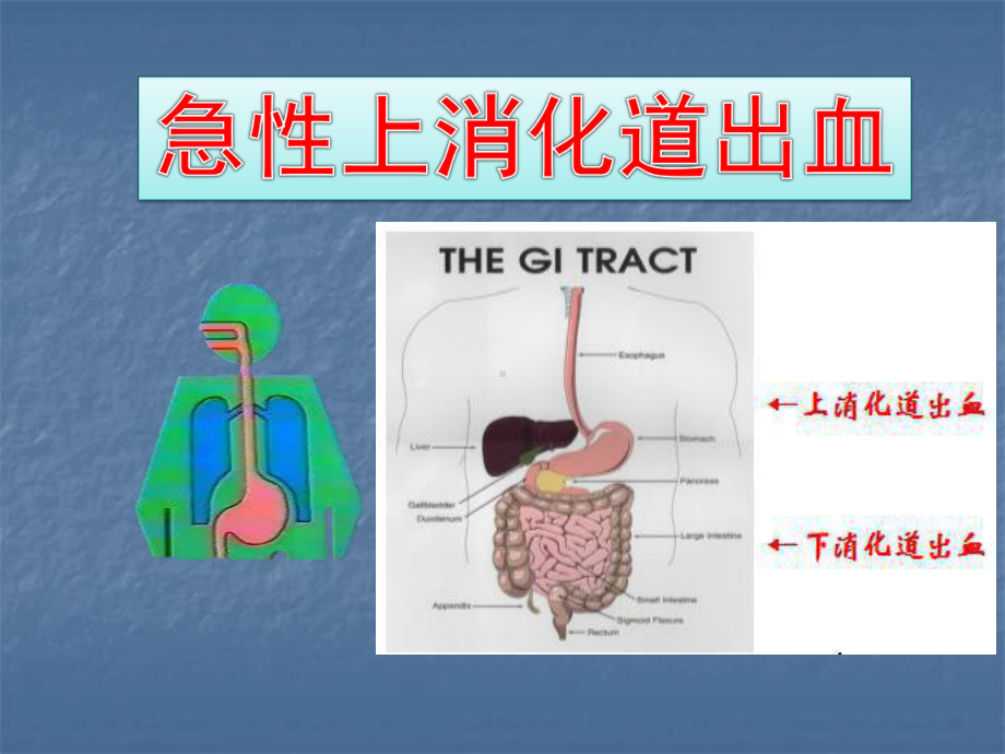 急性上消化道出血医学PPT课件.pptx_第2页