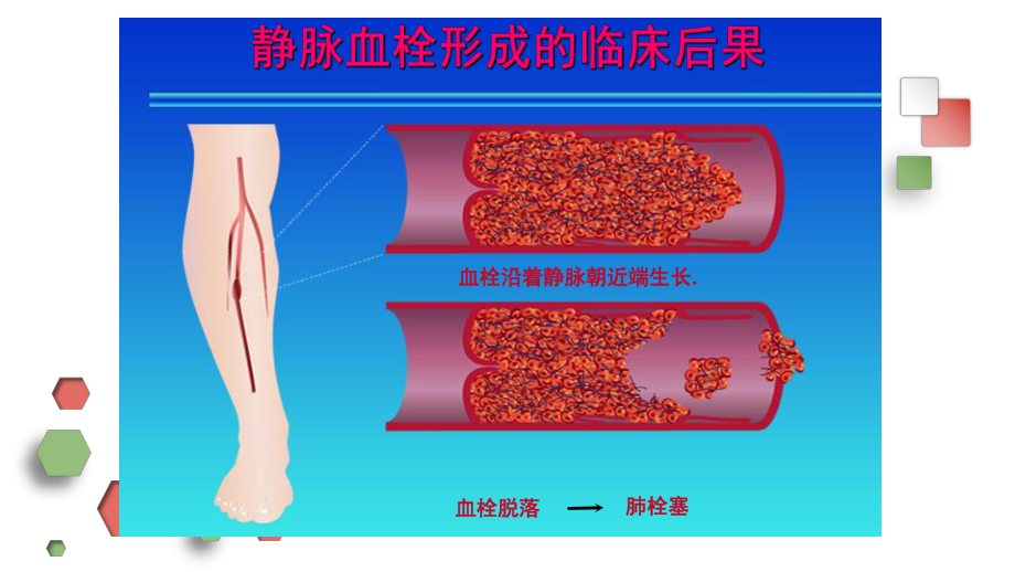 围手术期下肢深静脉血栓的预防及护理课件.pptx_第2页