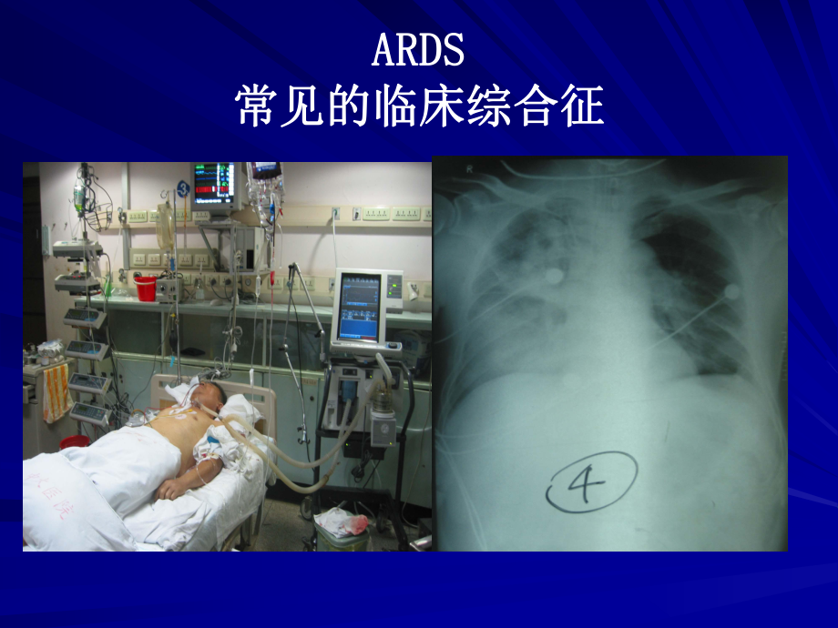 ARDS治疗策略资料课件.ppt_第3页