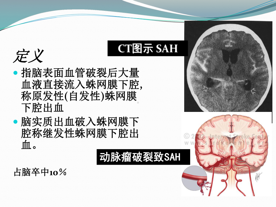 蛛网膜下腔出血诊治流程PPT课件.pptx_第2页