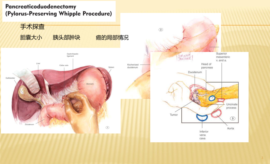 胰十二指肠切除术术式图解ppt课件.pptx_第3页