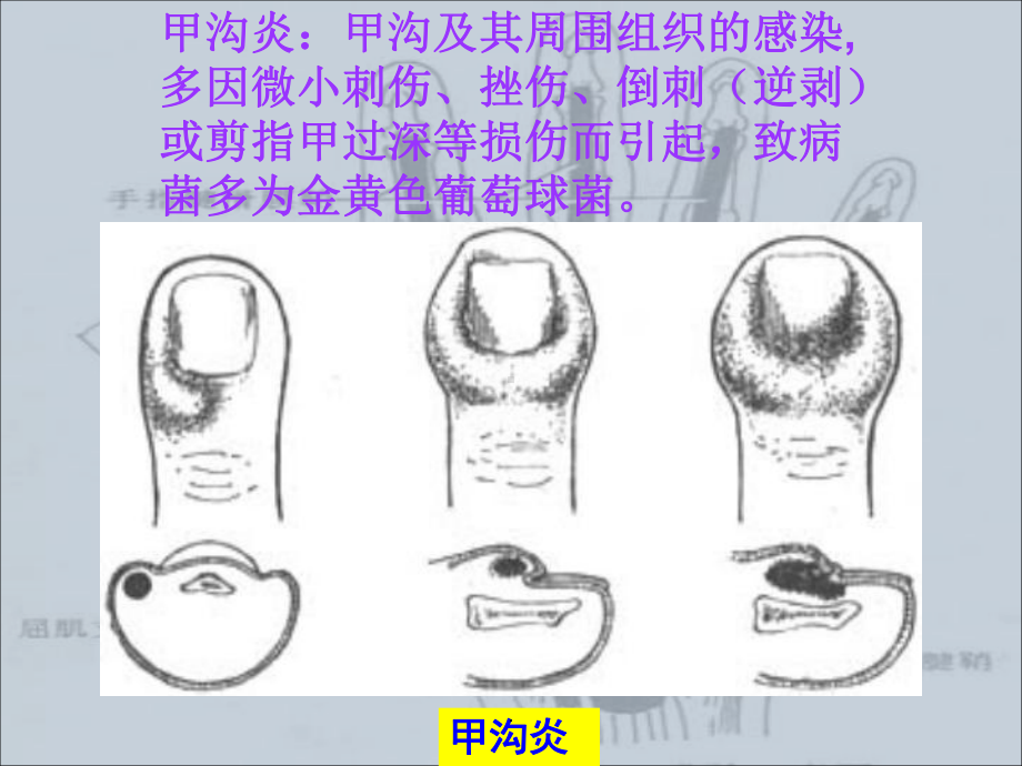 手部的化脓性感染PPT课件.ppt_第2页