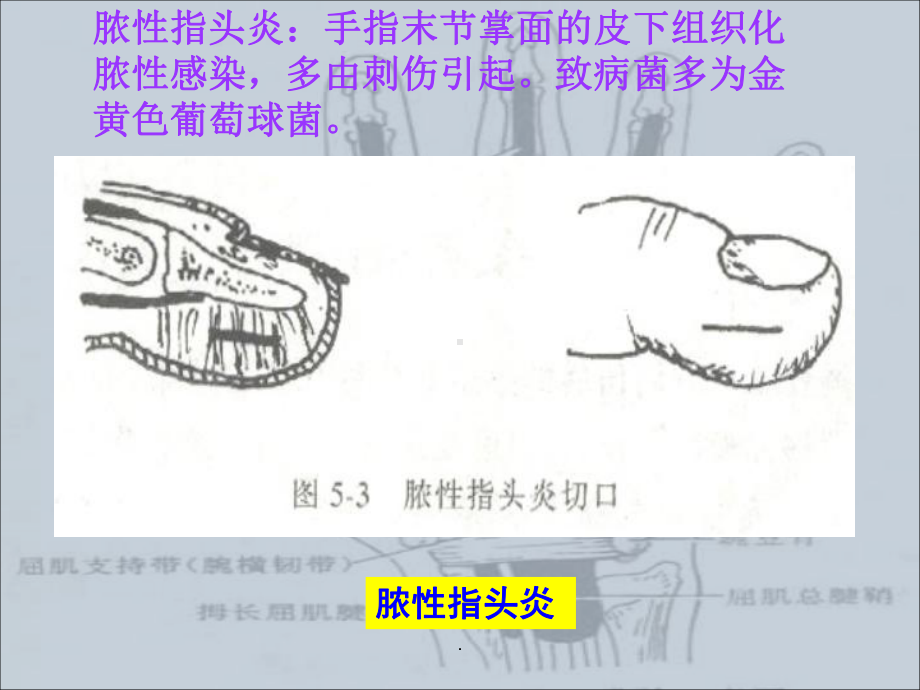 手部的化脓性感染PPT课件.ppt_第3页