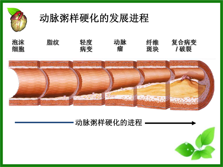 心肌梗死查房课件.ppt_第3页