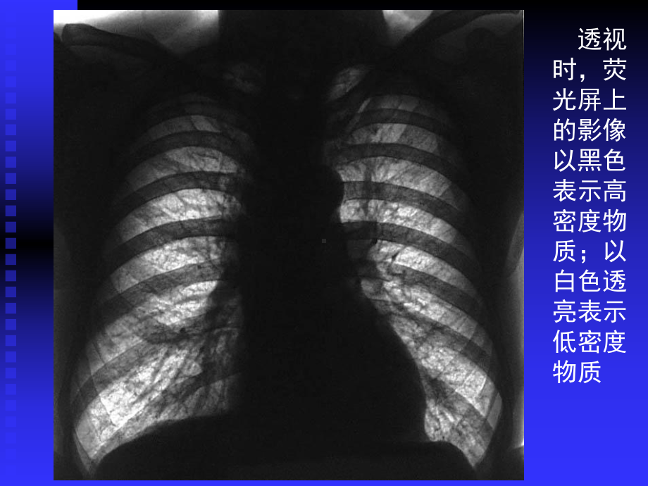 复旦肿瘤医院胸部影像学课件.ppt_第3页