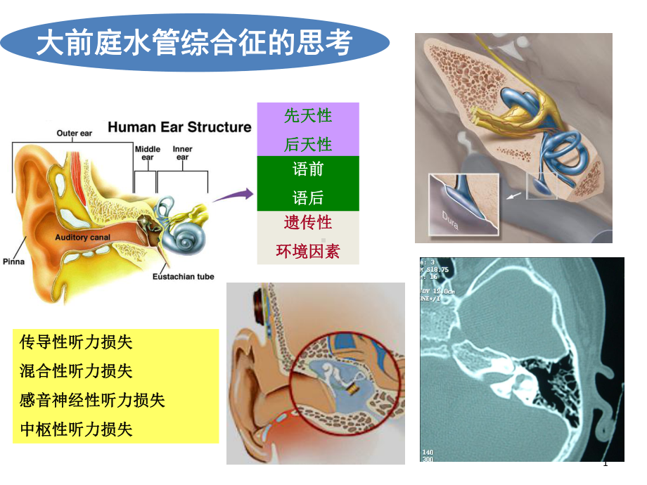 医学课件大前庭水管综合征的诊治.ppt_第1页