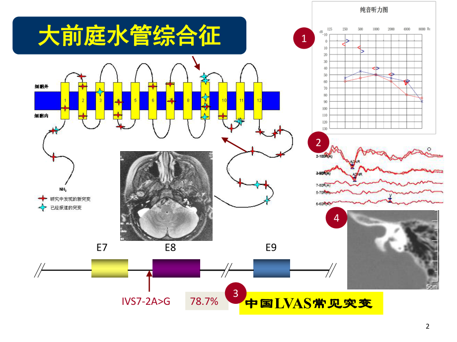 医学课件大前庭水管综合征的诊治.ppt_第2页