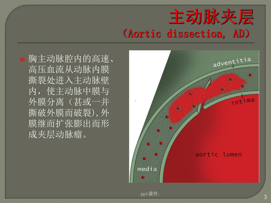 主动脉综合征ppt课件.ppt_第3页