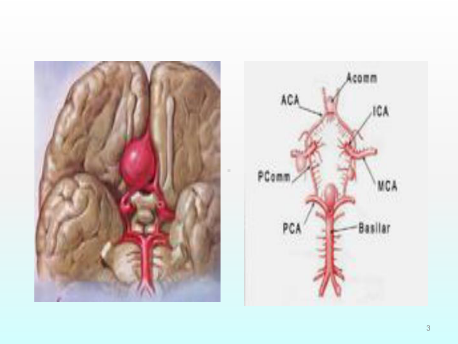 颅内动脉瘤的手术治疗ppt课件.ppt_第3页