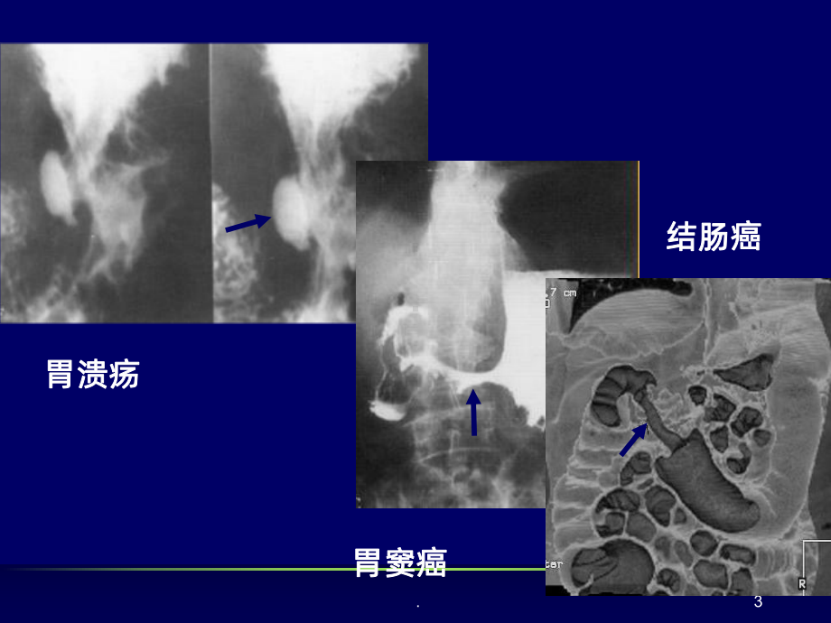 胃肠道正常影像表现基本病变PPT课件.ppt_第3页