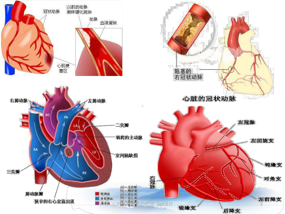 心肌梗死患者的护理-ppt课件.ppt_第3页