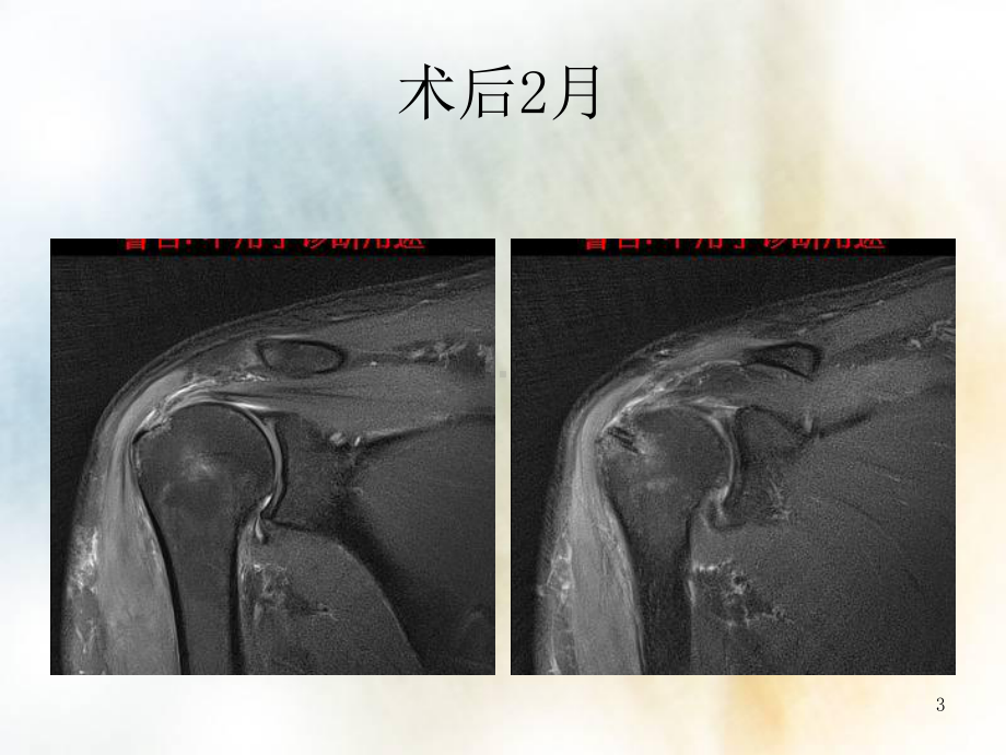 肩袖损伤的诊断及治疗课件.ppt_第3页