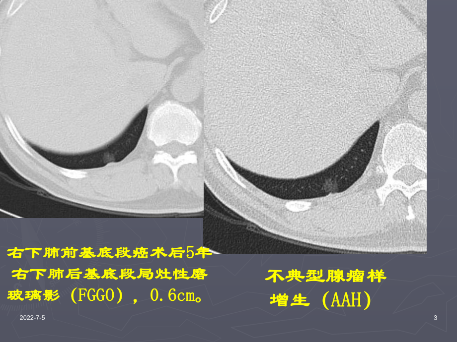 肺部结节的鉴别诊断资料课件.ppt_第3页