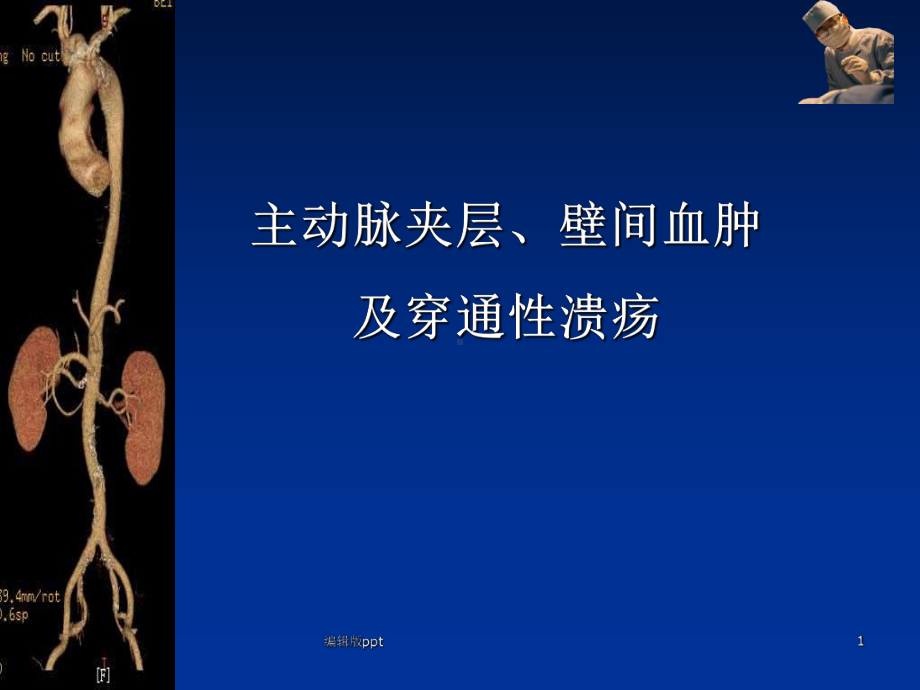 主动脉夹层壁间血肿及穿通性溃疡课件.ppt_第1页