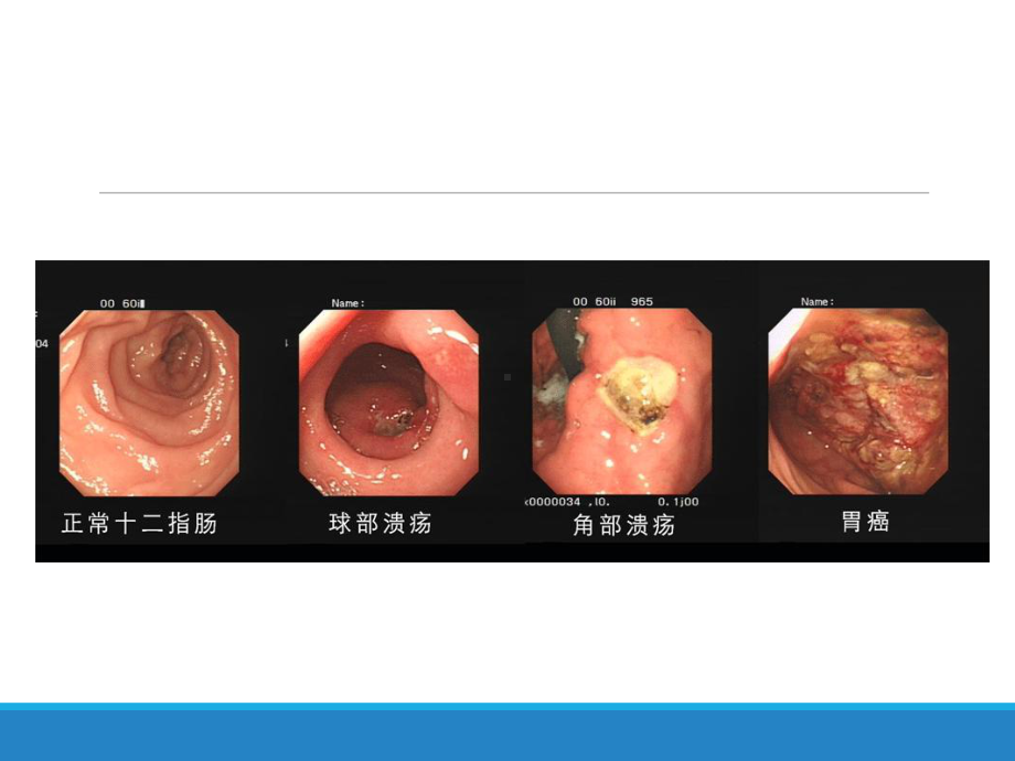 胃十二指肠溃疡的外科治疗课件.ppt_第2页