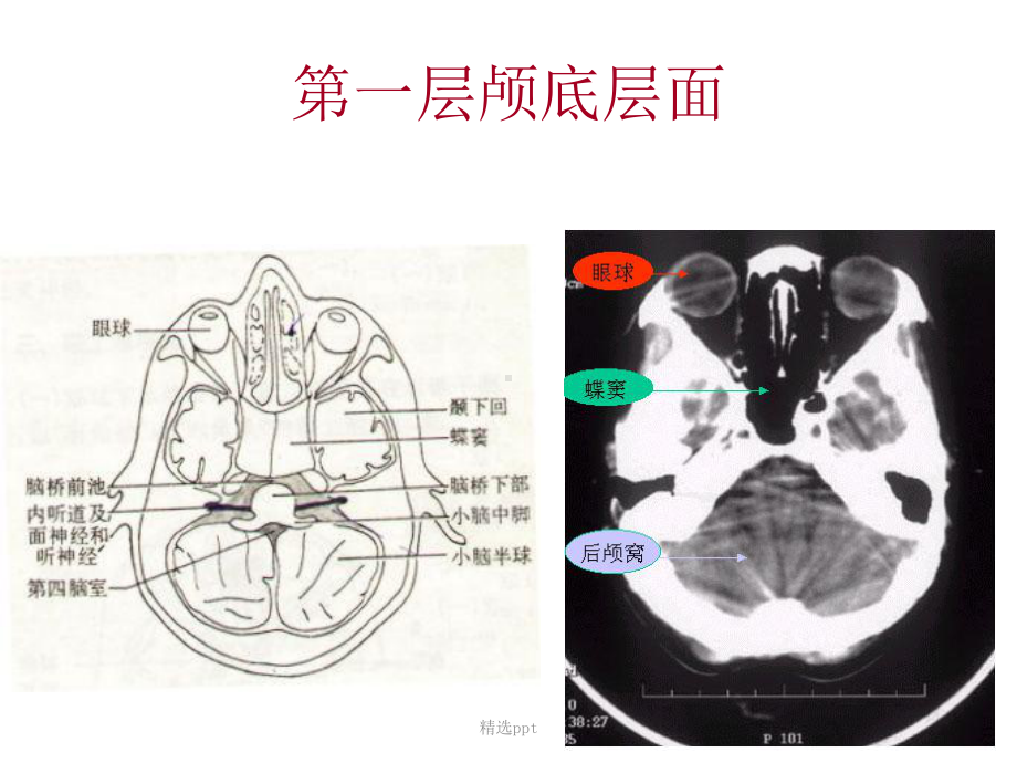 颅脑基本病变的CT诊断课件.ppt_第1页