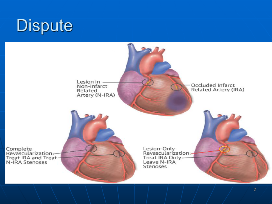急诊PCI中同期还是分期处理非犯罪血管PPT课件.pptx_第2页