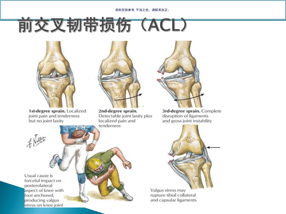 膝关节常见运动损伤讲课课件.ppt_第3页