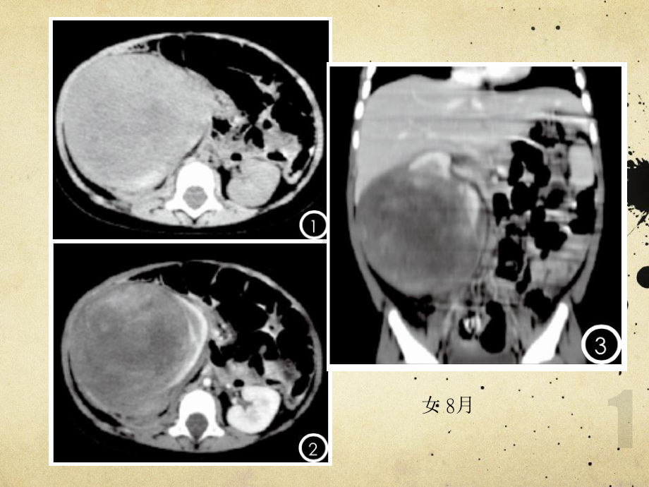 肾母细胞瘤-ppt课件.pptx_第1页