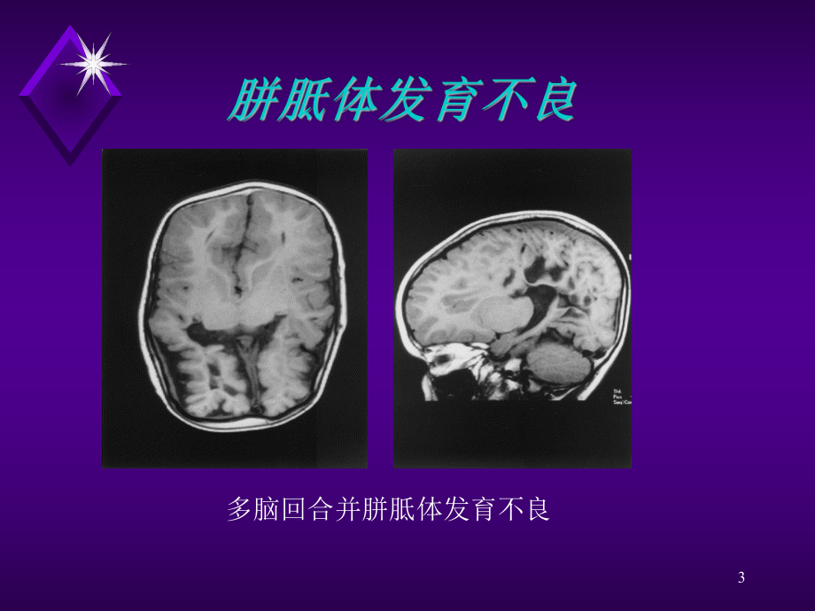 颅脑病变的MRI诊断1课件.ppt_第3页