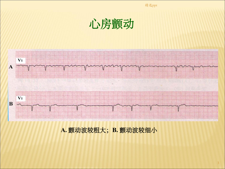 心房颤动与扑动心电图课件.ppt_第3页