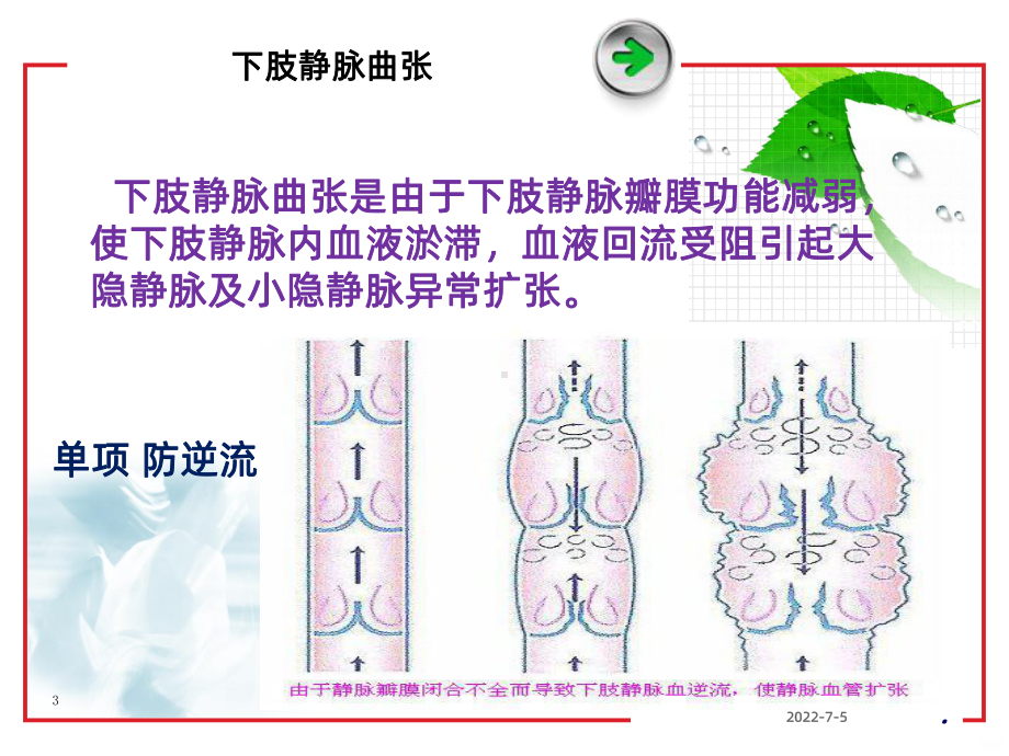 -下肢静脉曲张的预防和治疗PPT课件.ppt_第3页