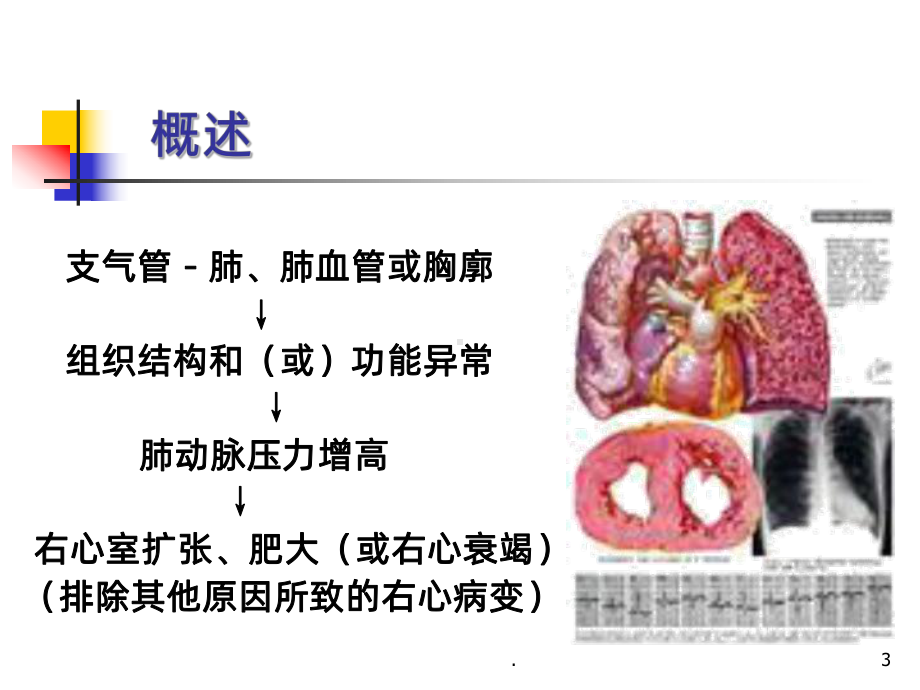 慢性肺源性心脏病(1)ppt课件.ppt_第3页