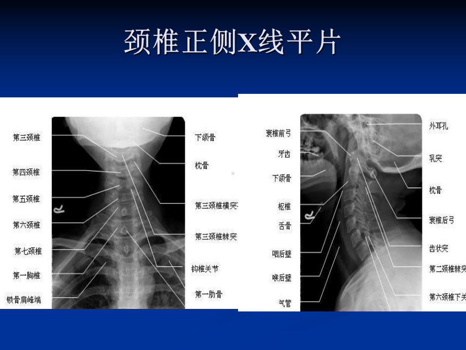 脊柱常见疾病影像学诊断课件.ppt_第3页