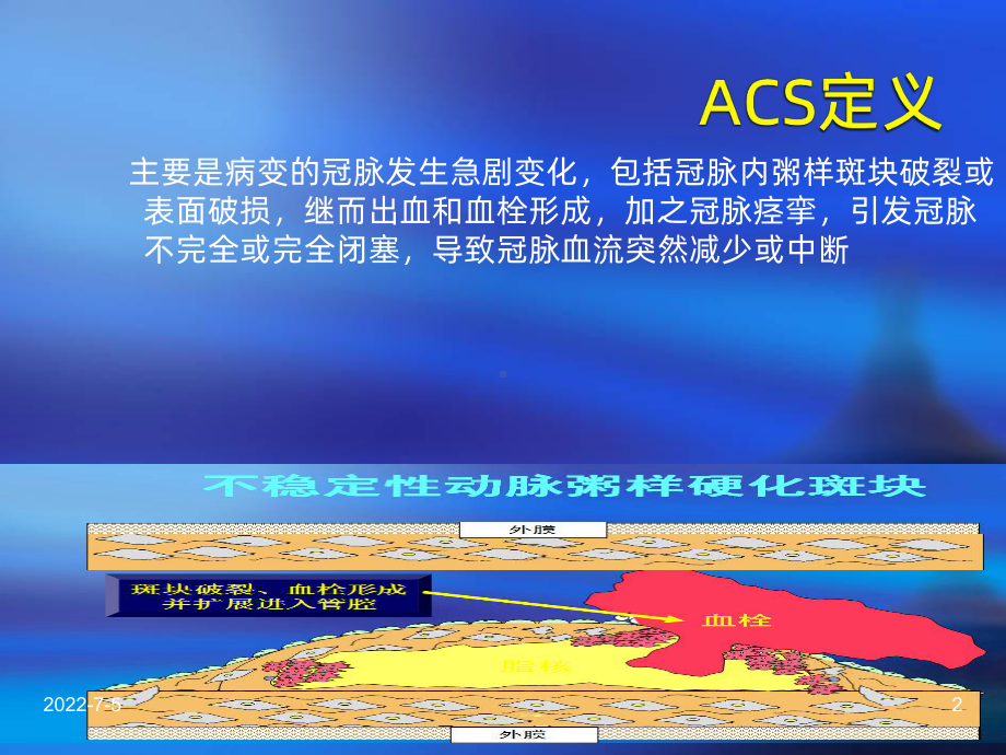 急性冠脉综合征护理查房PPT课件2.ppt_第2页