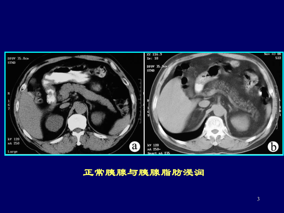 胰腺常见病变的CT诊断PPT课件.ppt_第3页