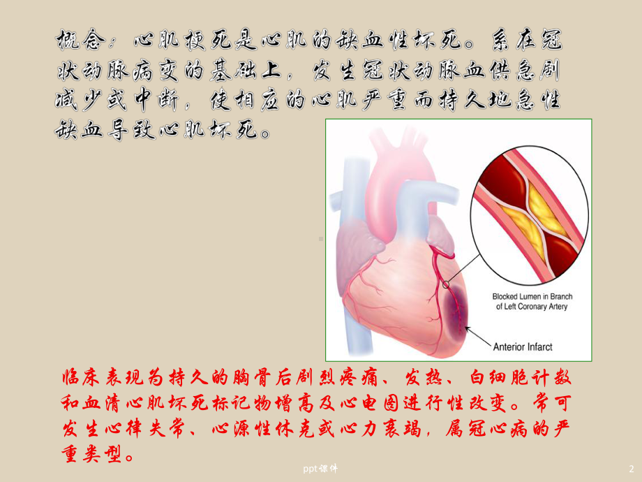 心肌梗死的护理常规-ppt课件.ppt_第2页