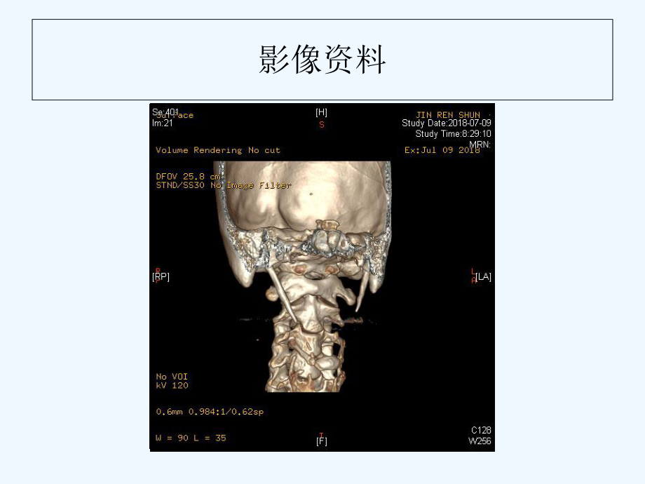 茎突过长综合征-PPT课件.ppt_第3页