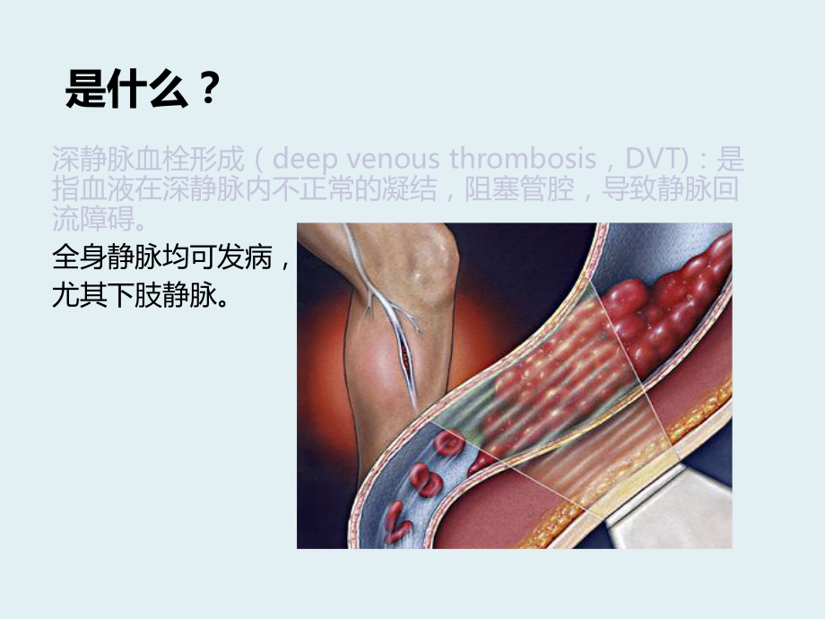 深静脉血栓健康宣教ppt课件.ppt_第3页