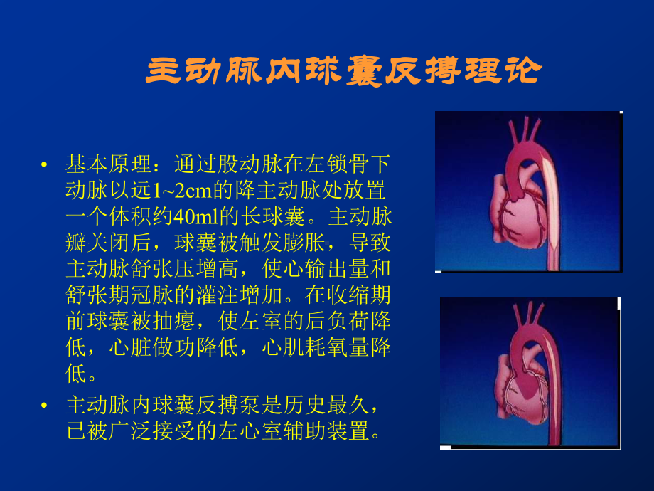 主动脉内球囊反搏教学课件.ppt_第3页