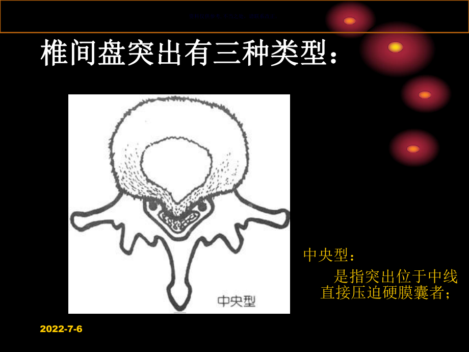 椎间盘突出的影像诊断课件.ppt_第3页