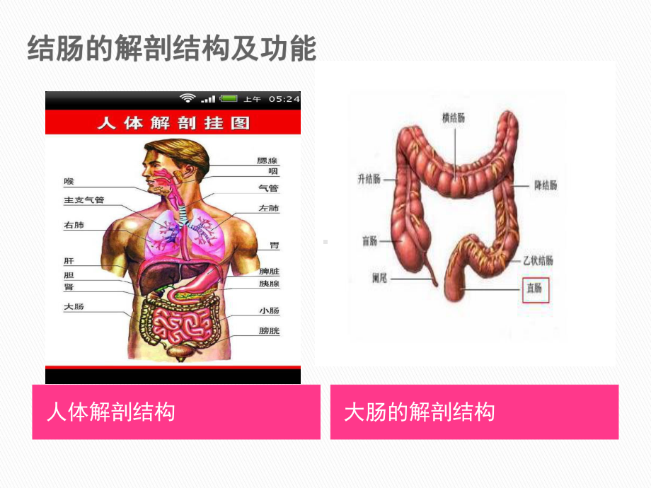 溃疡性结肠炎的护理查房课件.ppt_第3页