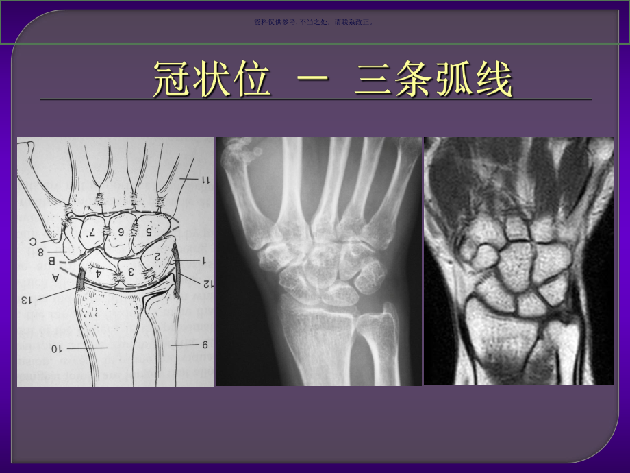 腕关节病变的MRI诊断课件.ppt_第3页