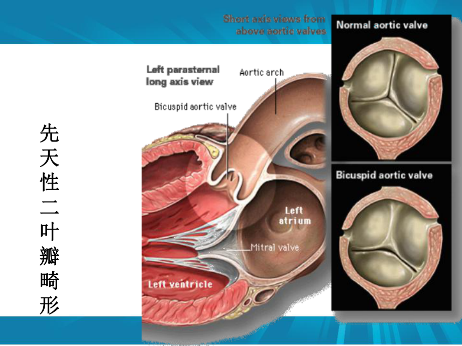 主动脉瓣+肺动脉瓣课件.pptx_第3页