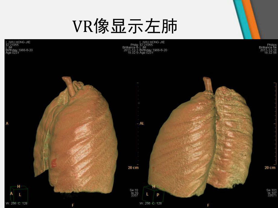 胸部CT解剖要点和常见疾病诊断课件.ppt_第3页