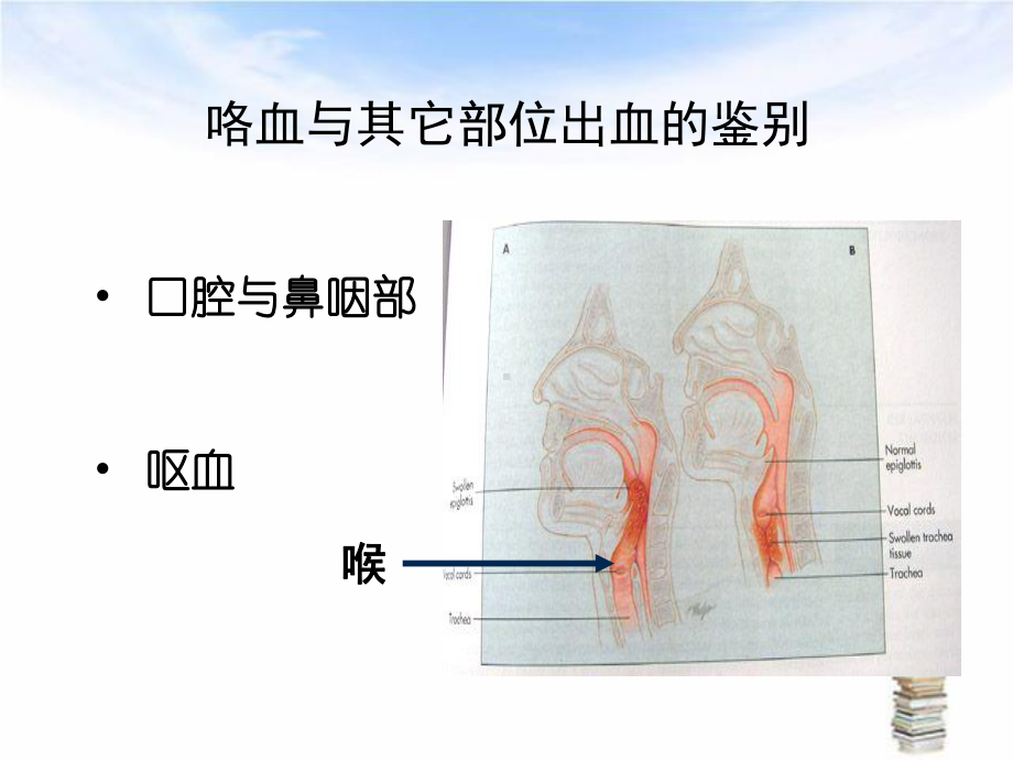 咯血的诊疗和处置讲义课件.ppt_第3页