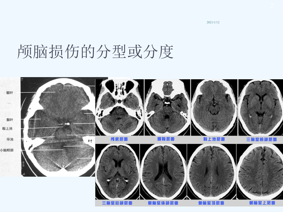 重度颅脑损伤监护与治疗课件.ppt_第2页