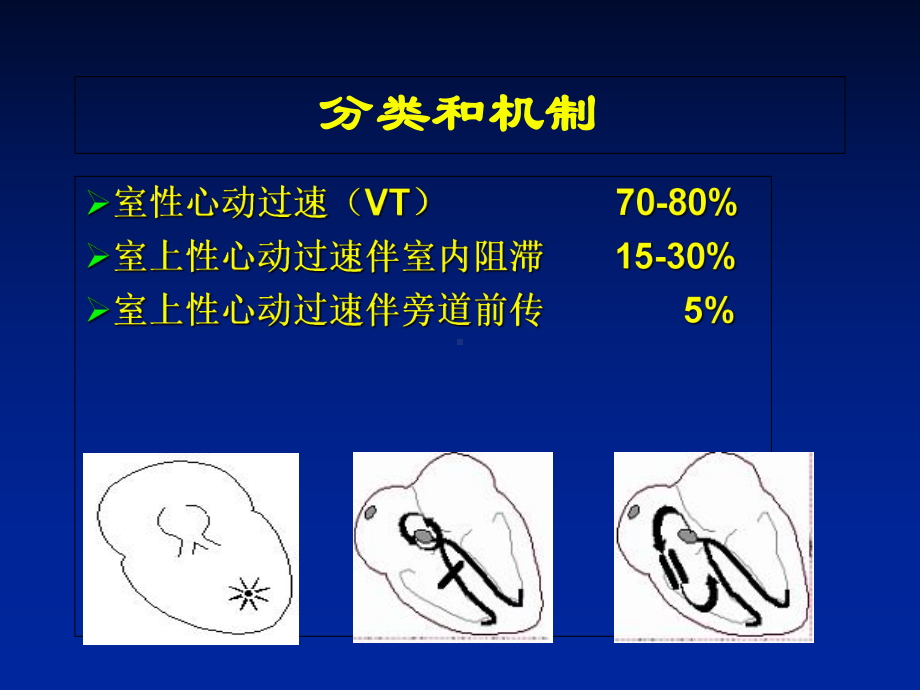 宽QRS心动过速的诊断和处理课件.ppt_第3页