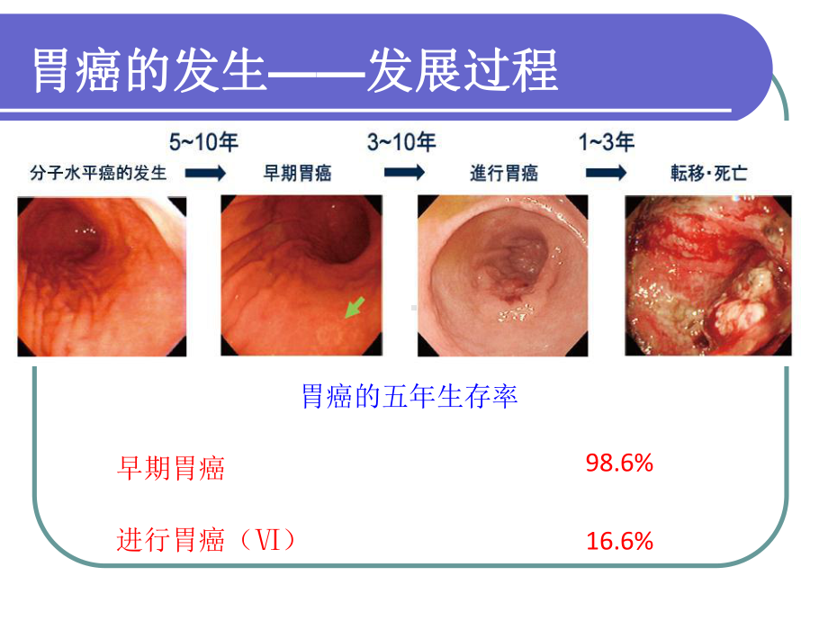 早期胃癌诊断的一点体会课件.ppt_第3页