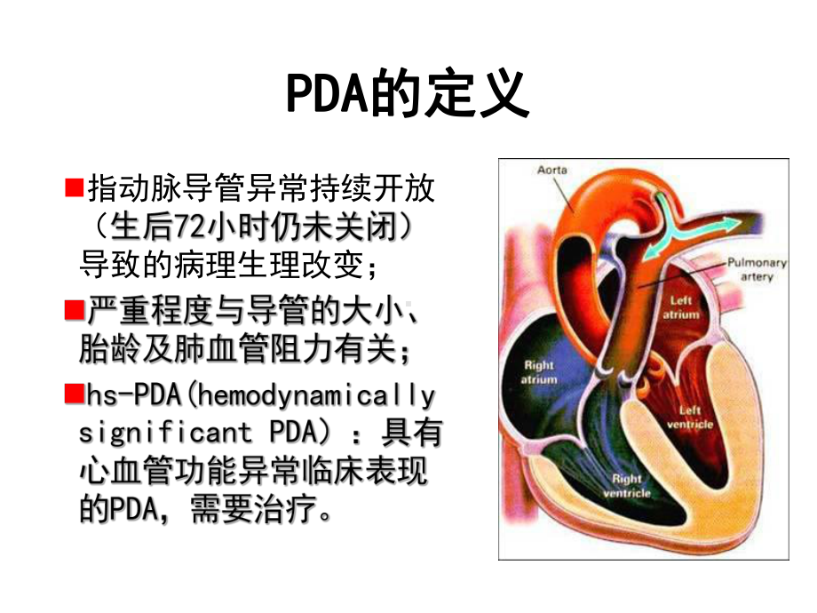 早产儿动脉导管未闭管理课件.ppt_第2页