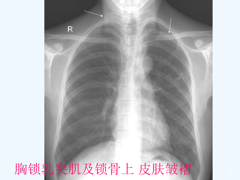 影像学呼吸系统正常影像表现课件.ppt_第3页