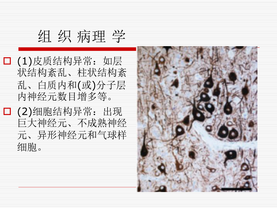 局灶性脑皮质发育不良课件.ppt_第3页