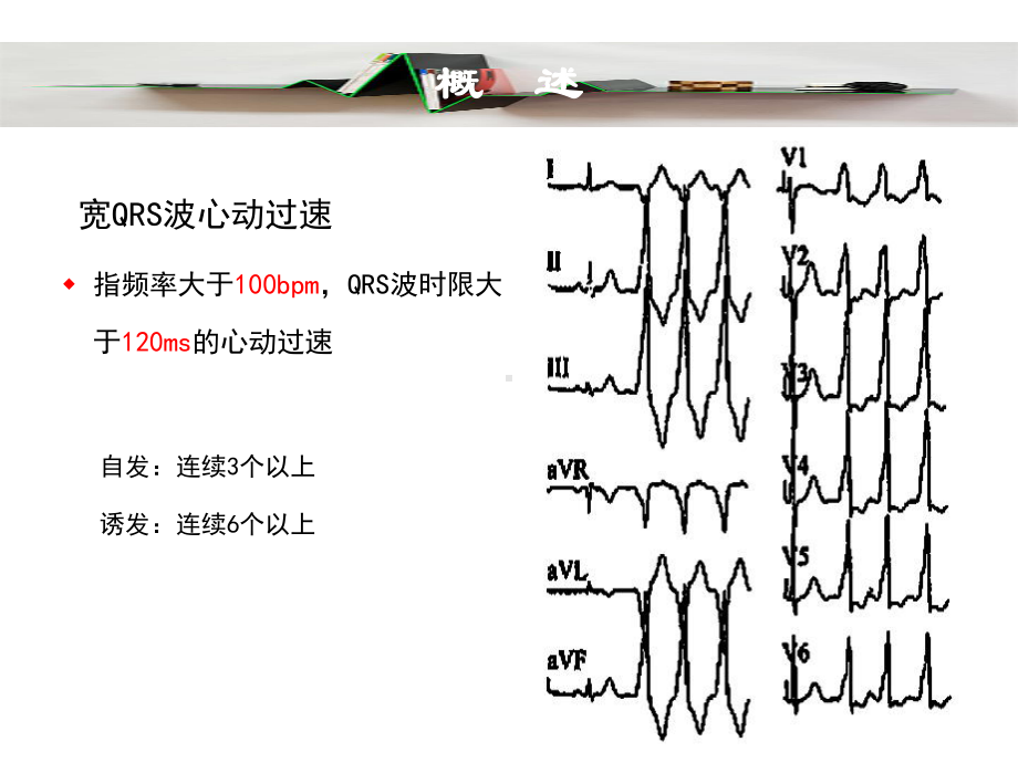 宽QRS波群心动过速鉴别诊断新思路课件.ppt_第3页