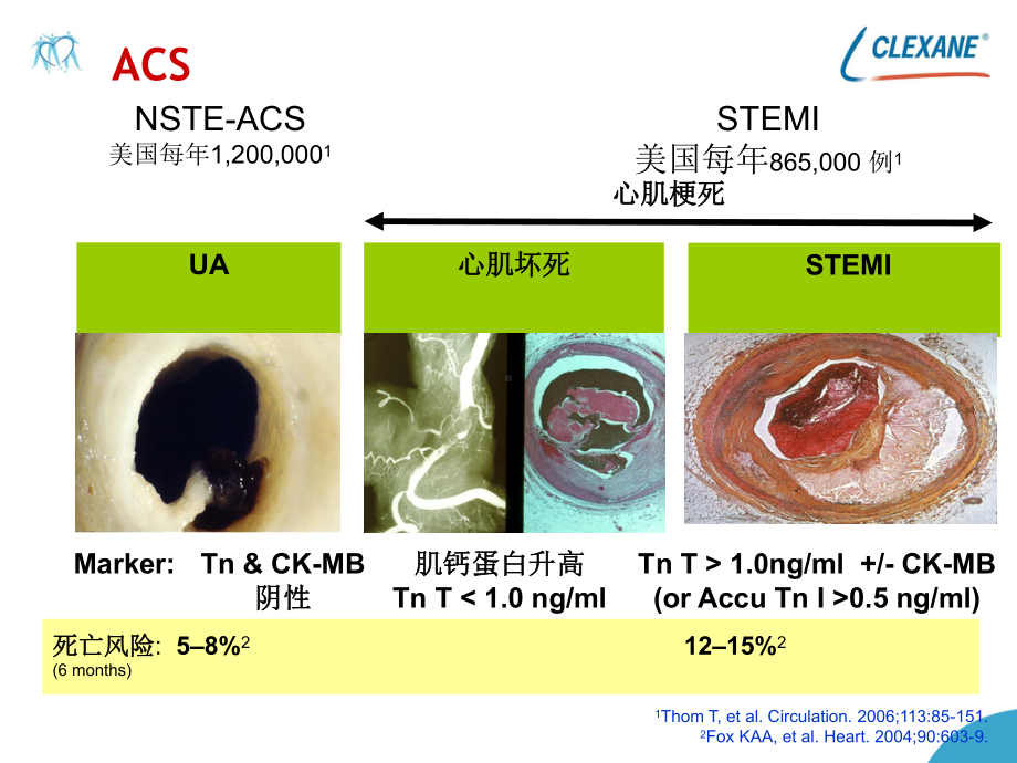 探索STEMI抗凝、抗血小板治疗临床管理策略课件.ppt_第2页