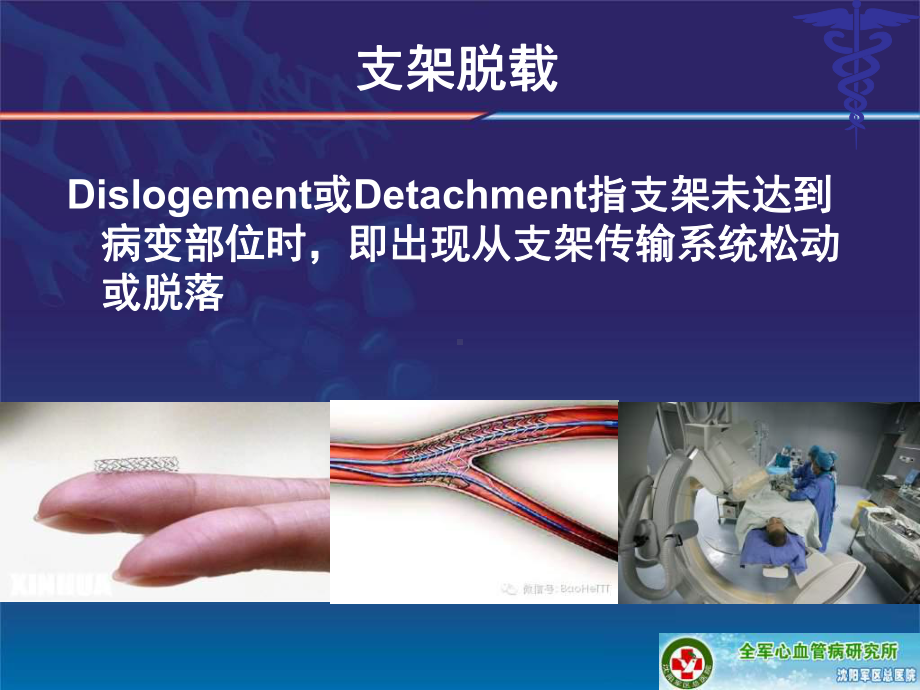 支架脱载原因与处理StentDislodgementDuringPCI课件.ppt_第2页